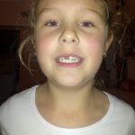 Front tooth missing